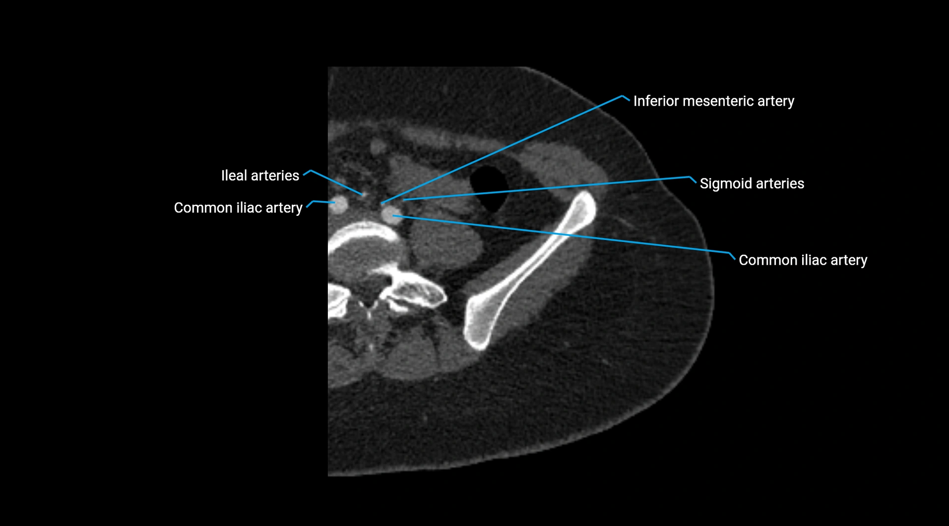 CTA lower limb cross sectional anatomy labelled image _10.webp